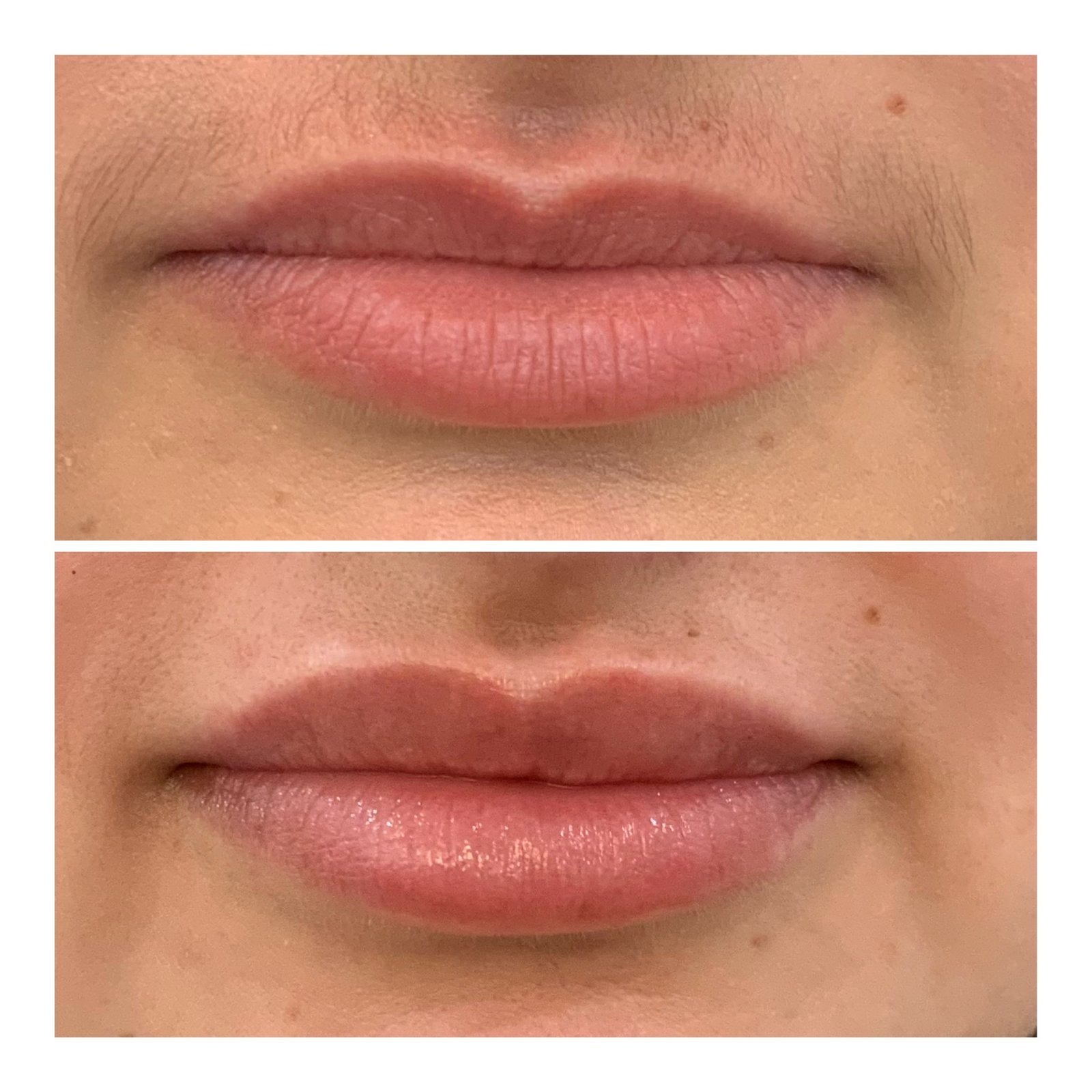 dermal lip fillers near me