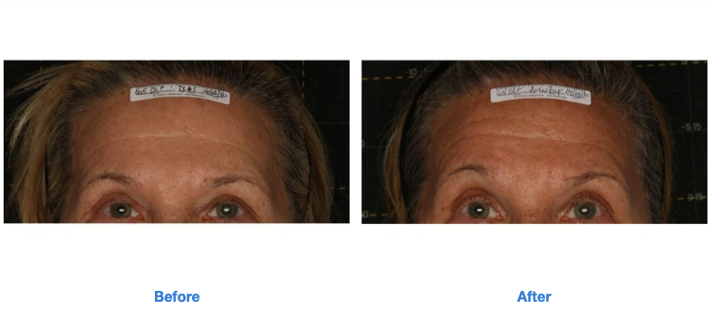 Sofwave Before and After (1)