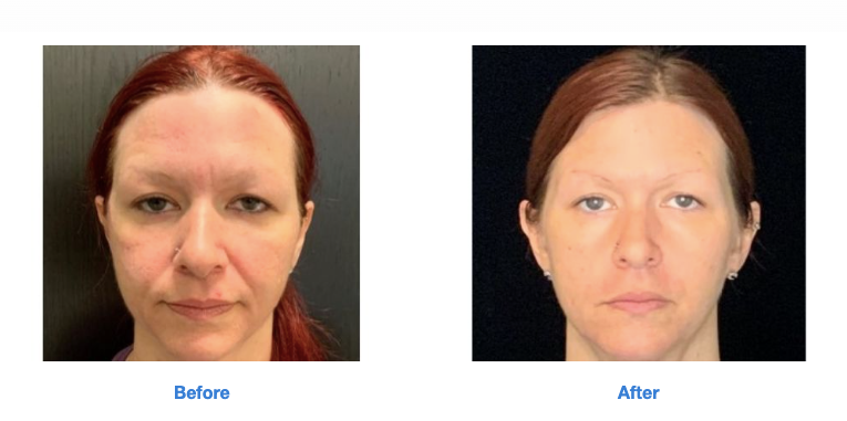 Sofwave Before and After (2)