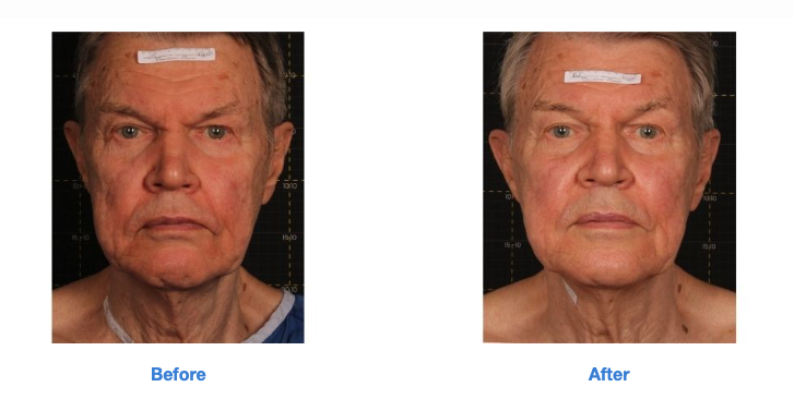Sofwave Before and After (3)
