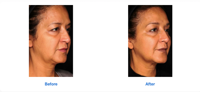 Sofwave Before and After (7)