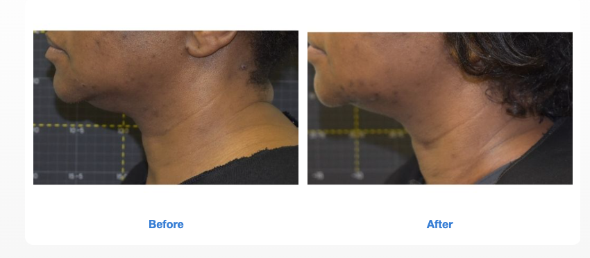 Sofwave Before and After (8)