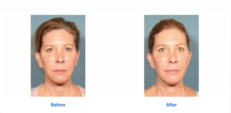 Sofwave Before and After