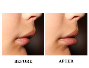 Incorrect bite in a child. Malocclusion in children. Lip profile
